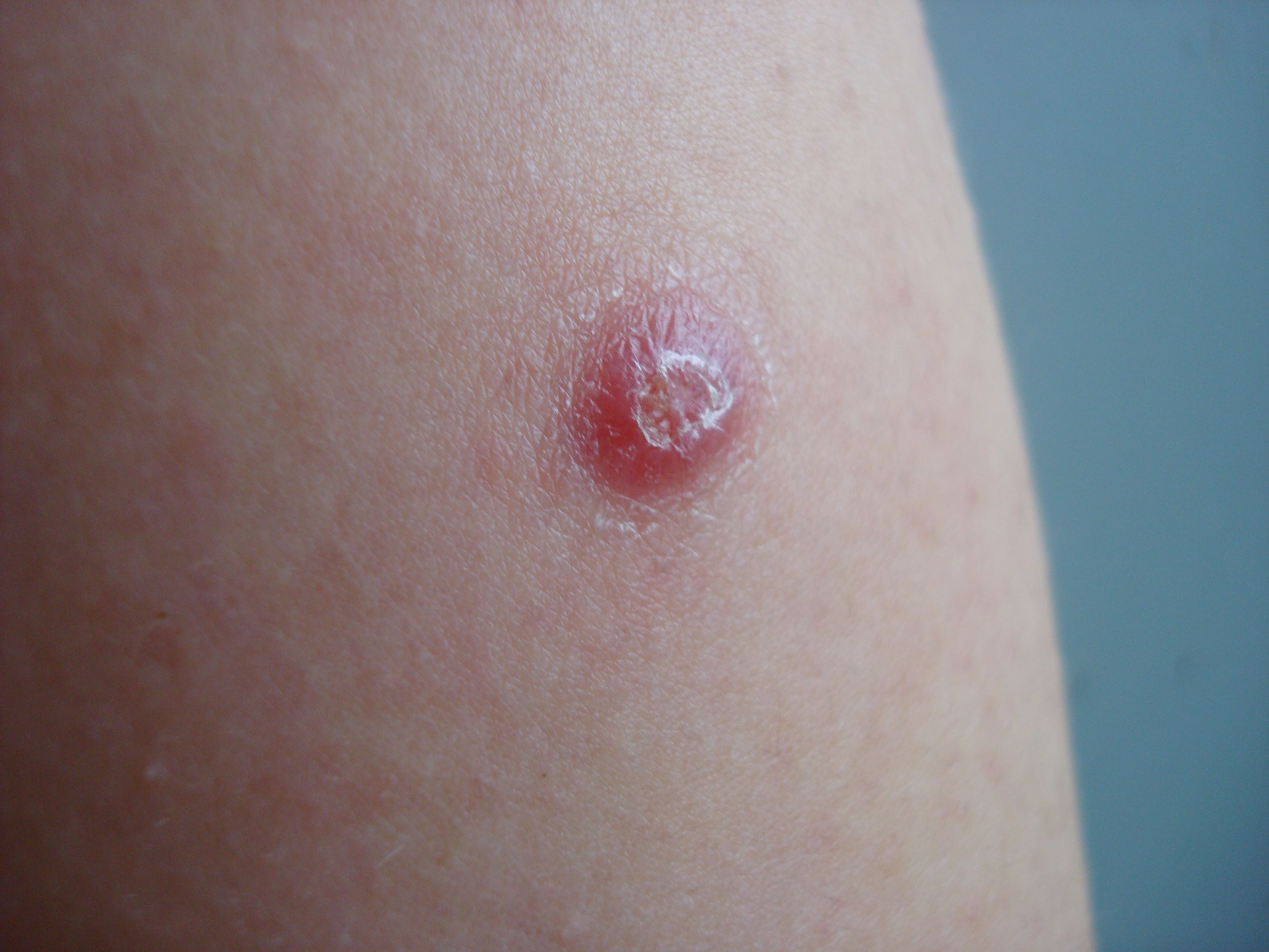TB Vaccine BCG Available In Brisbane
