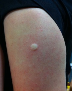 Immediately after TB vaccine; note white bubble on skin 